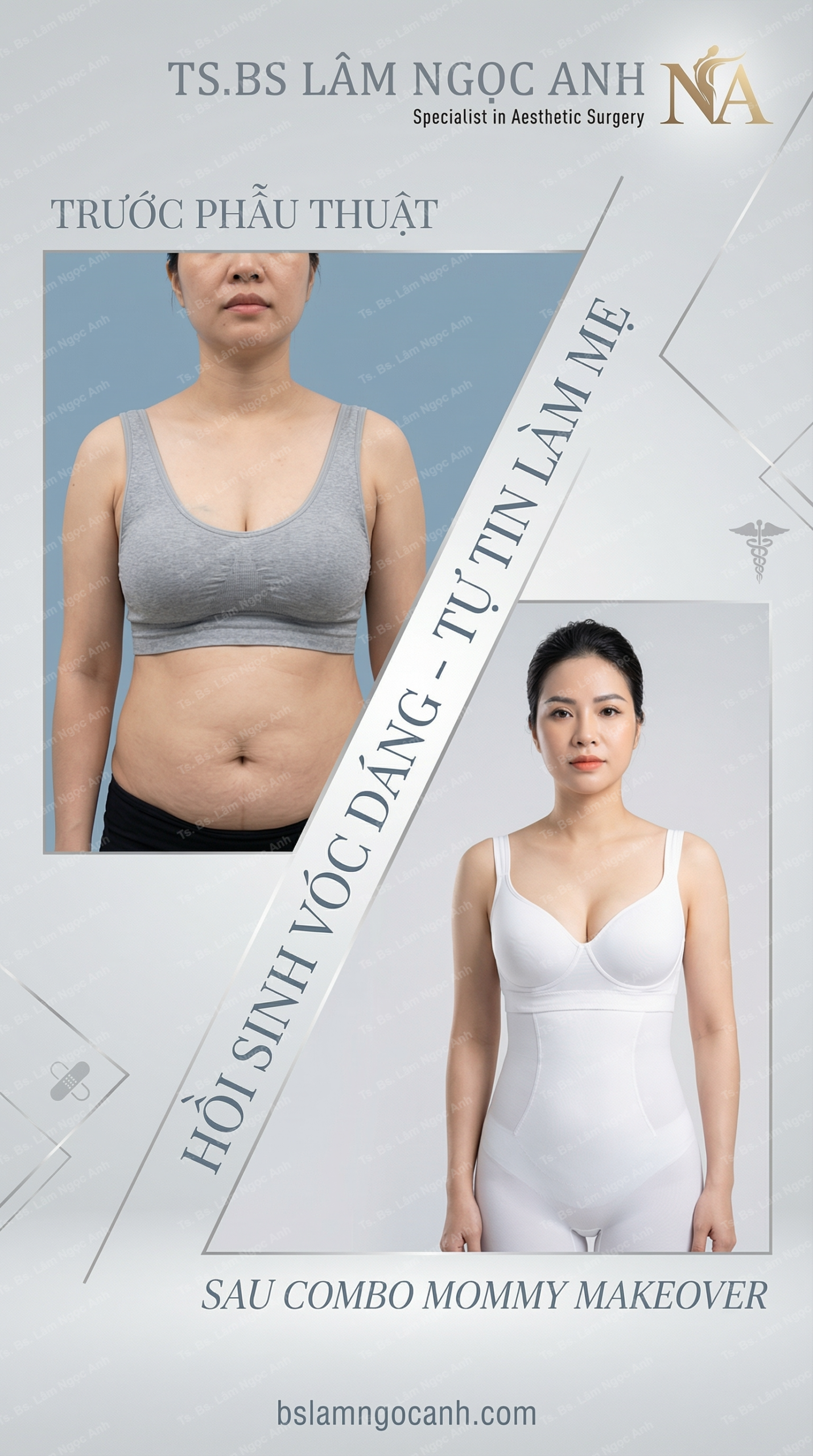 Hút Mỡ Bụng Tạo Đường Cong: Hành Trình Lấy Lại Vòng Eo Phẳng Lì Cùng TS.BS Lâm Ngọc Anh